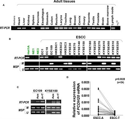 PCDH20 inhibits esophageal squamous cell carcinoma proliferation and migration by suppression of the mitogen-activated protein kinase 9/AKT/β-catenin pathway